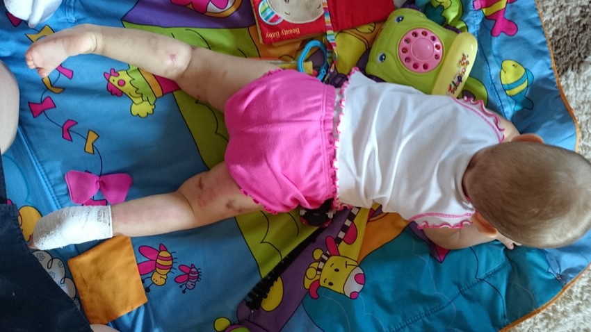 A járványos agyhártyagyulladás nyomai a kicsi testén