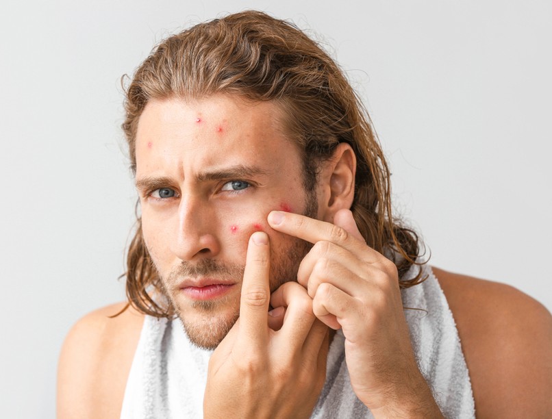 férfi, pattanás, miteszer, kozmetikus, szappan, arcszesz, természetes, vitaminok