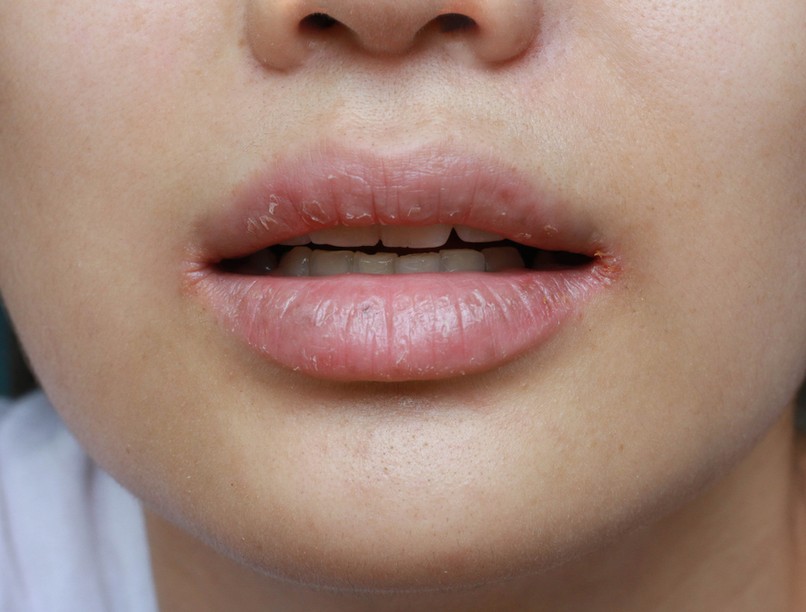 szájsarok-gyulladás, szájzug-gyulladás, Cheilitis angularis, candida, fertőzés, tünetei, kezelése, szájpenész