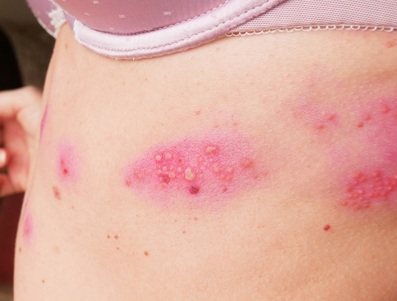 övsömör, koronavírus oltás, covid19, Varicella Zoster