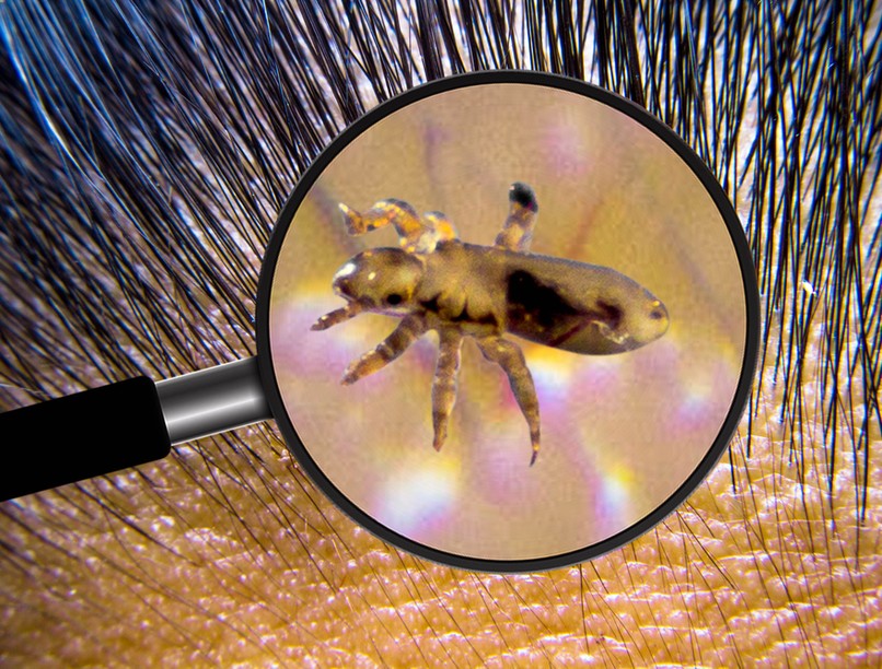 tetvek, tetvesség, vér, serke, fejbőr, haj, hajtetvek, fejtetű