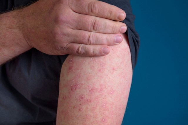 Bőr alatti meszes csomók: ilyen komoly autoimmun betegség állhat mögötte