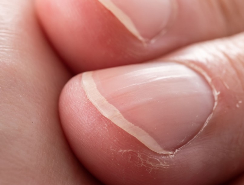 köröm vonalak jelentése vesebetegség tünet jel