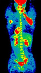 Sugárveszély nélkül is kimutatható daganatok?