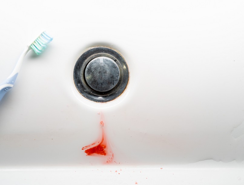 ínyvérzés, hátterében ok betegség