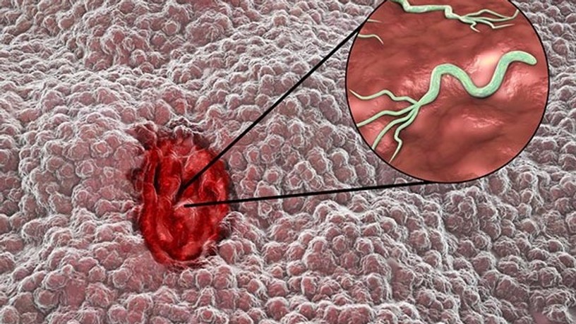 gyomorfekély, helicobacter pylori, baktérium, fertőzés, kórokozó