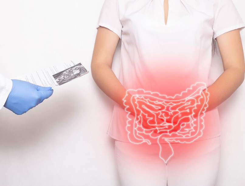 bélgyulladás Crohn betegség, autoimmun, tünetei, kezelése