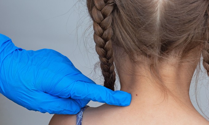 Egyik napról a másikra kijöhetnek  új anyajegyek az erős napsütéstől? Az orvos válaszol című cikk nyitóképe