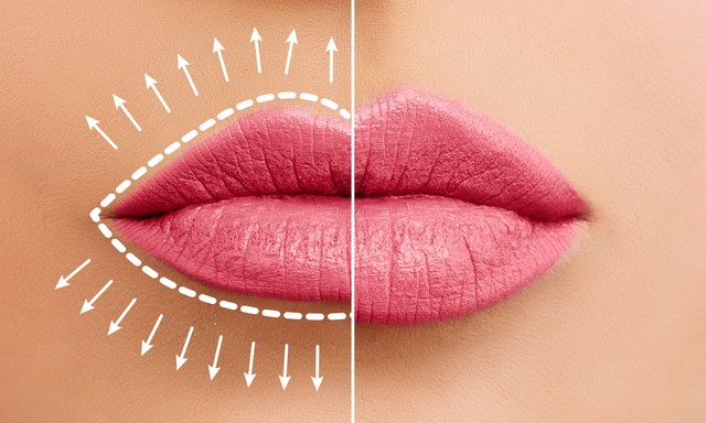 Itt vannak az eredmények: így gondolkodnak az emberek az ajakfeltöltésről