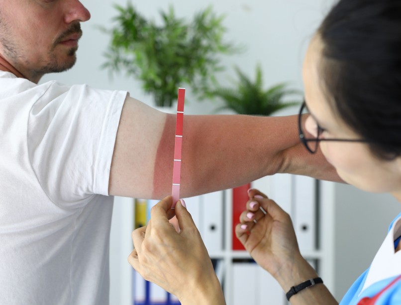 bőrgyógyász tanács nap sugárzás védekezés leégés