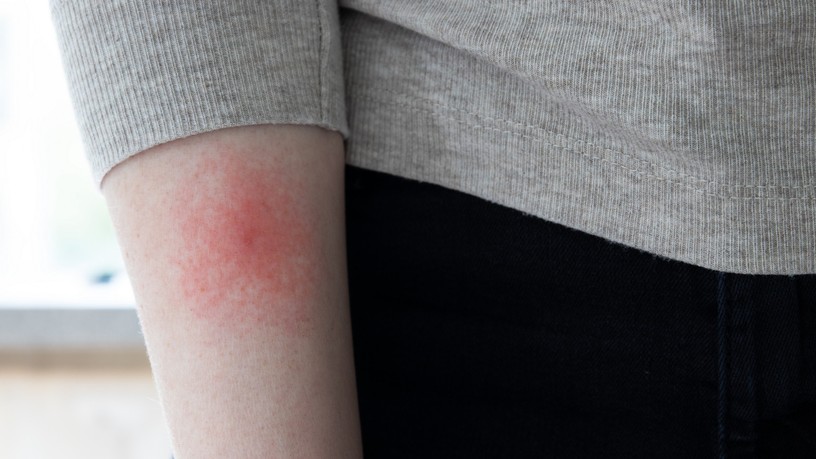 lyme kor tünet, diagnózis
