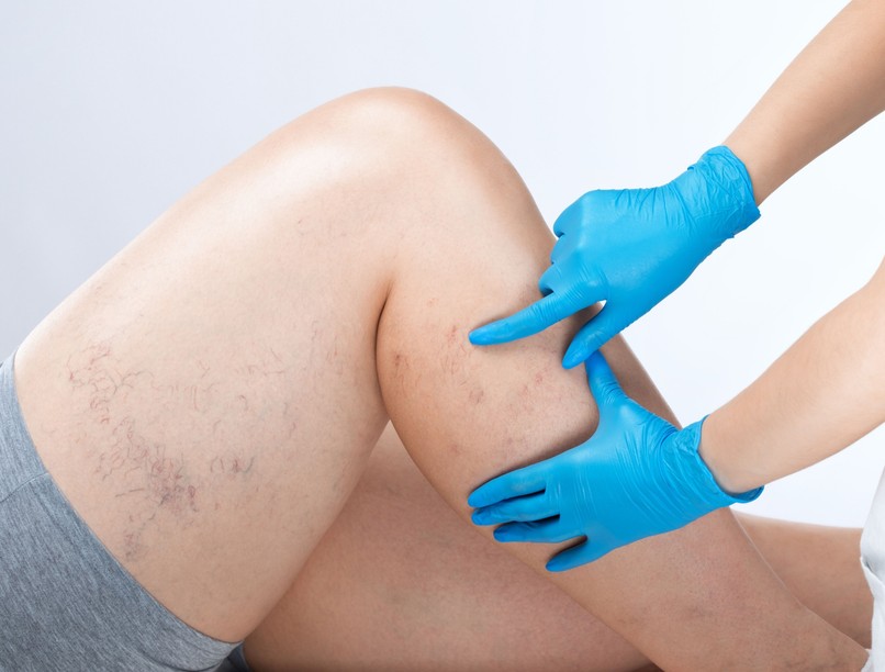 Lábszárfekély visszértágulat megelőzés kezelés