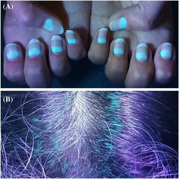 Bekékült a hajuk, körmük azoknak, akik favipiravirt szedtek a súlyos Covid ellen