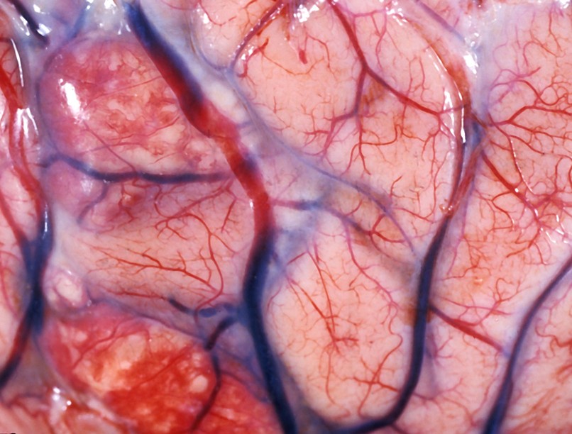 Agyhártyagyulladás-járvány meningitis fertőzés korai jele tünete