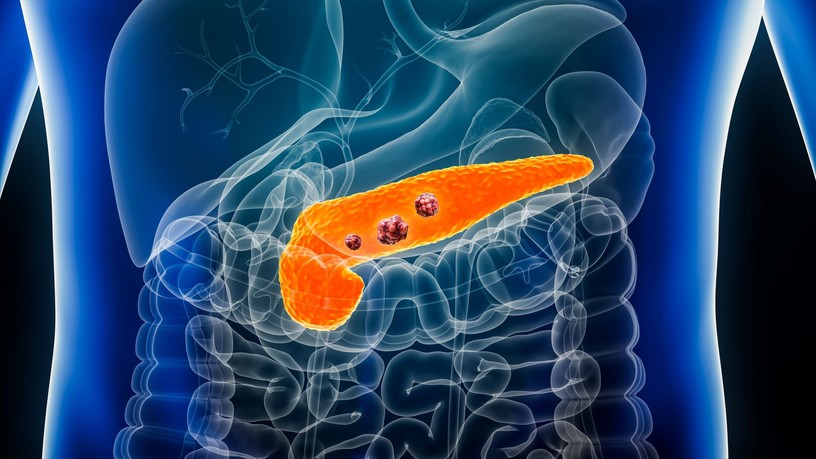 hasnyálmirigydaganat áttét immunterápia