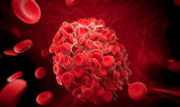 Valós veszélyek: a vénás trombózis