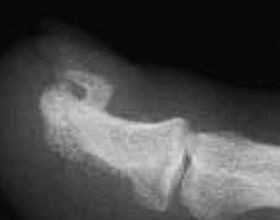 Oszteokondromatózis (Multiplex herediter exosztózis)