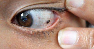  Melanóma a szemen: gyorsan áttétet képezhet! Ezt az elváltozást ne hagyja annyiban 