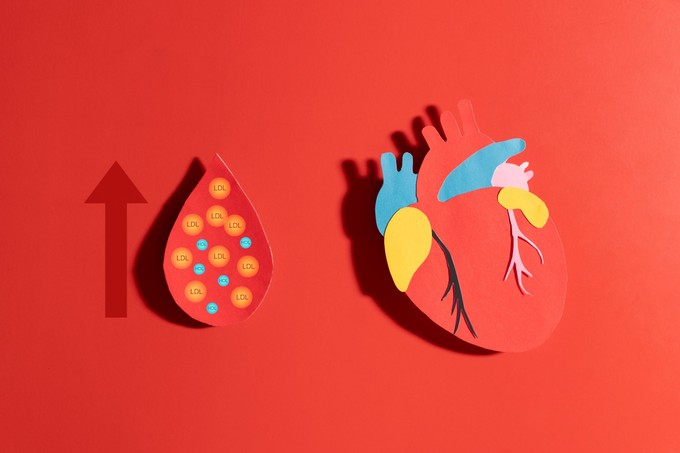 Ez az érelmeszesedés alig ismert rizikófaktora - pedig ilyen egyszerűen kimutatható a vérből című cikk nyitóképe