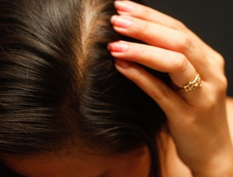 670px-choose-the-right-hair-loss-option-step-3