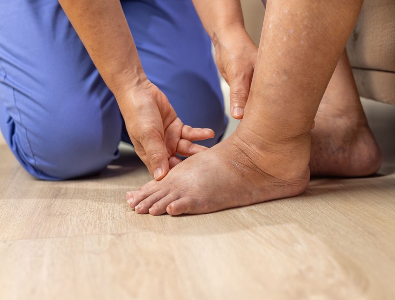 lábdagadás mitől dagad be a láb estére