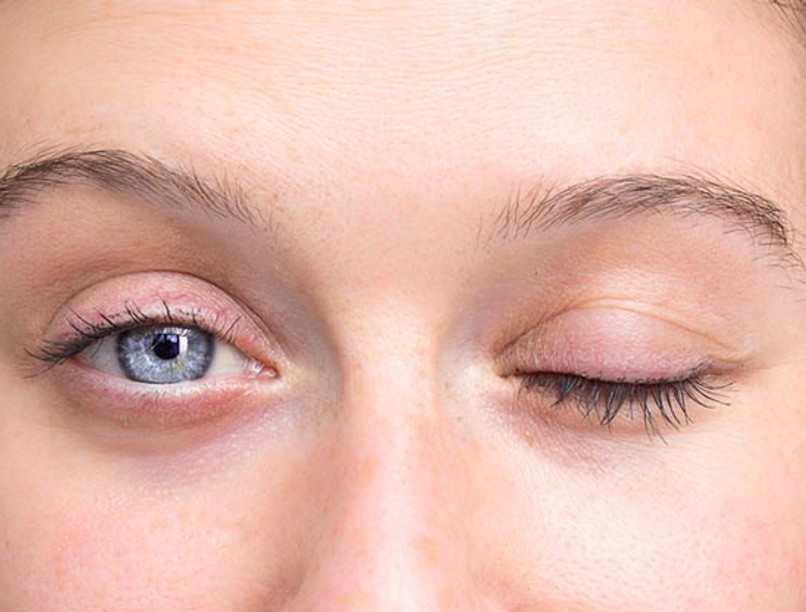 Mi a gyakori pislogás nystagmus