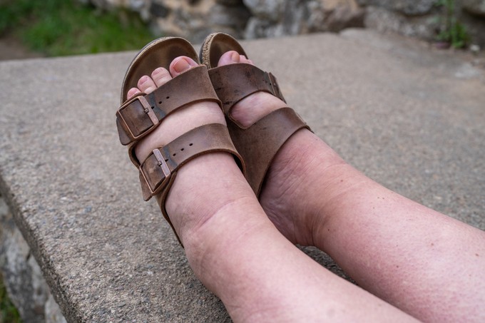 Duzzadt lábak és karok? Lehet, hogy nyiroködéma áll a háttérben című cikk nyitóképe