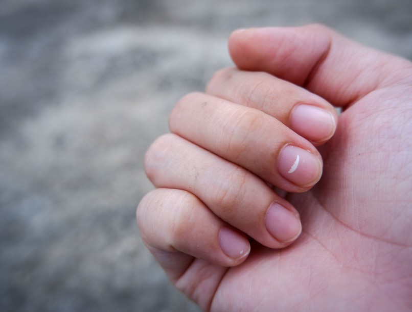 kálciumhiány, tünetei, kálcium, kálciumpótlás, D-vitamin