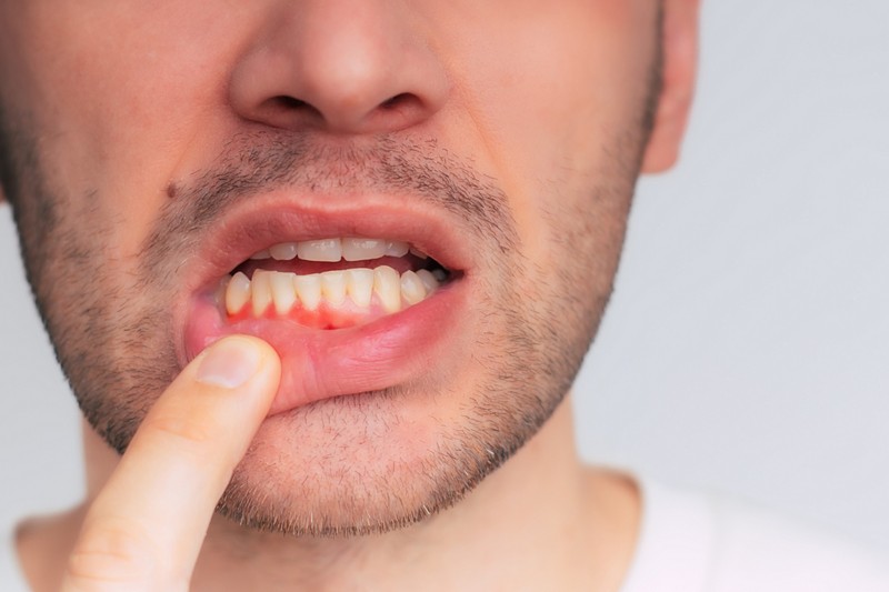 Ezek a cukorbetegség korai jelei a fogakon, a fogínyen és a szájban