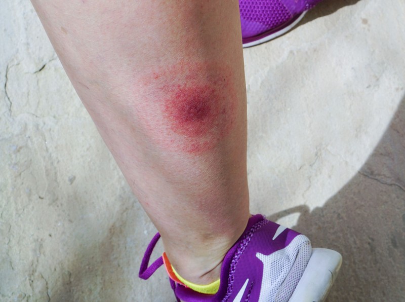 Kullancscsípés után mikor forduljuk orvoshoz? Így döntheti el