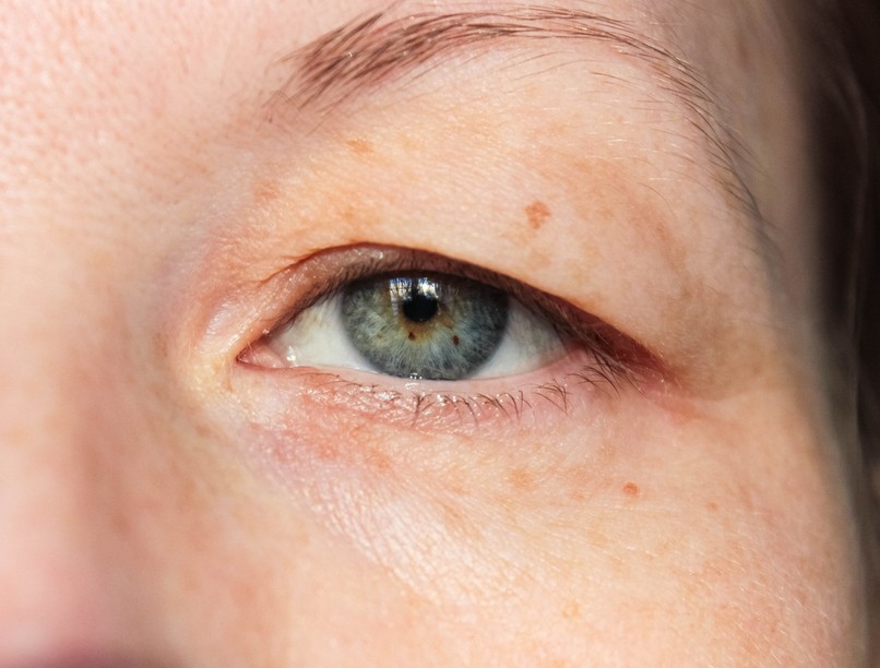 myasthenia gravis, szemhéjcsüngés, tünet