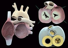 Orvosi siker: műszív-beültetés