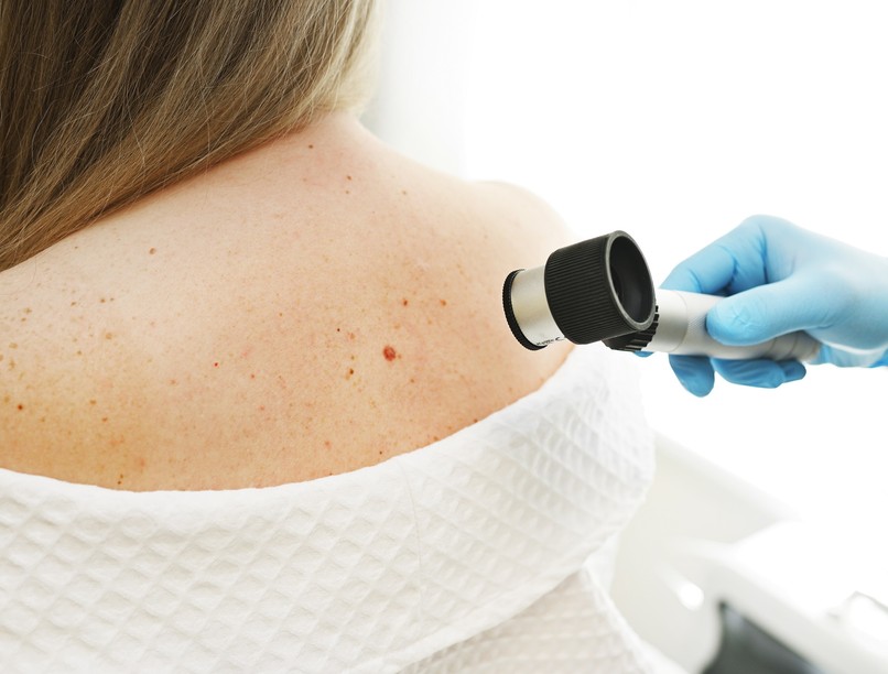 melanoma diagnózis kérdés orvos