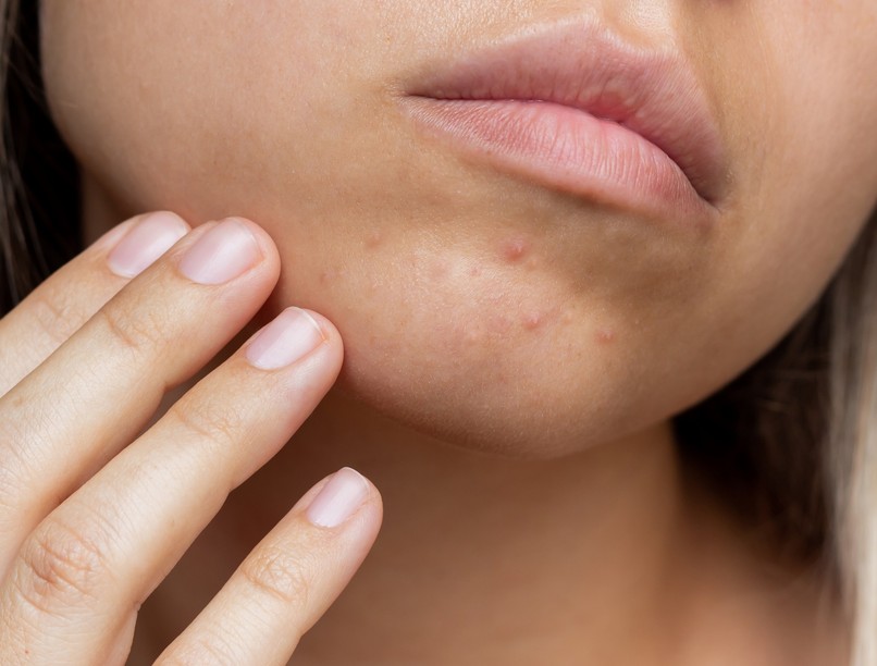 pattanás, akné nyomkodás, gennyes duzzanat