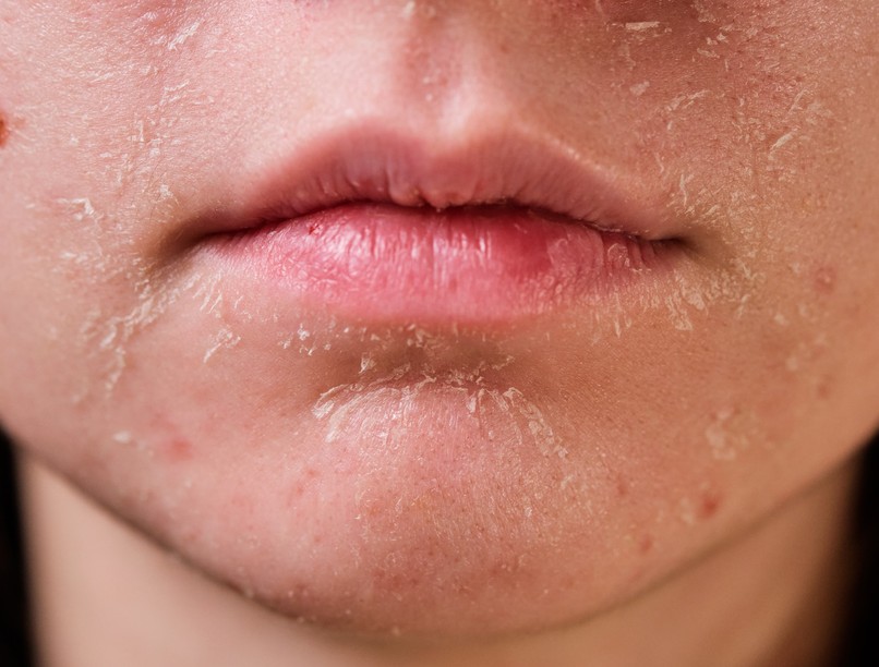 gyomorrák első korai jele arc bőr hámlás