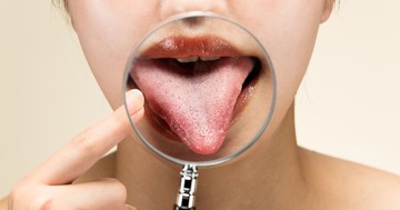  A nyelvrák első jelei, amiket szinte mindenki félreért 