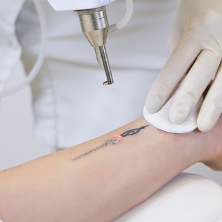 Tetováltatás véralvadásgátló mellett - az orvos elárulja, biztonságos-e című cikk nyitóképe
