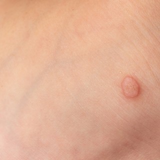 Szemölcse van? Ezért jobb, ha orvosra bízza! című cikk nyitóképe