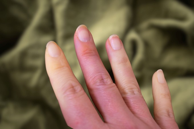 Ezért rosszabbodnak a Raynaud-szindróma tünetei hideg időben című cikk nyitóképe