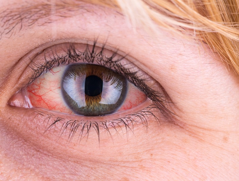 A vörös foltok a szemfehérjén, magas vérnyomásra utalhatnak!