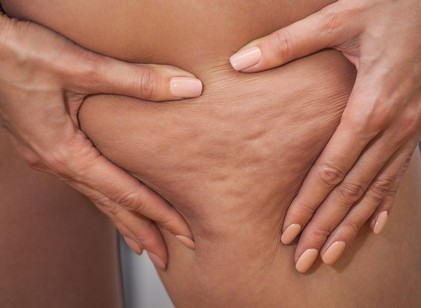 Lipödéma vagy cellulit? Sokan összekeverik, pedig nem ugyanaz című cikk nyitóképe