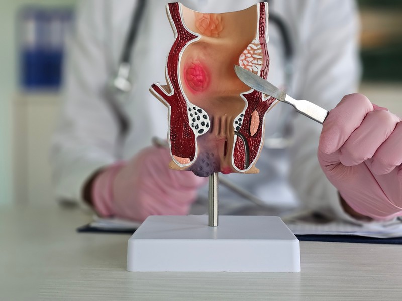 Divertikulum (béltágulat): tüntei, vizsgálata és kezelési lehetőségei