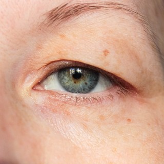 Szemhéjcsüngés: ritka betegség árulkodó jele is lehet! Ebből tudhatja ha érintett című cikk nyitóképe