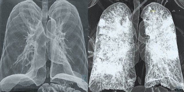 Mi a tüdő CT és mit mutat ki?