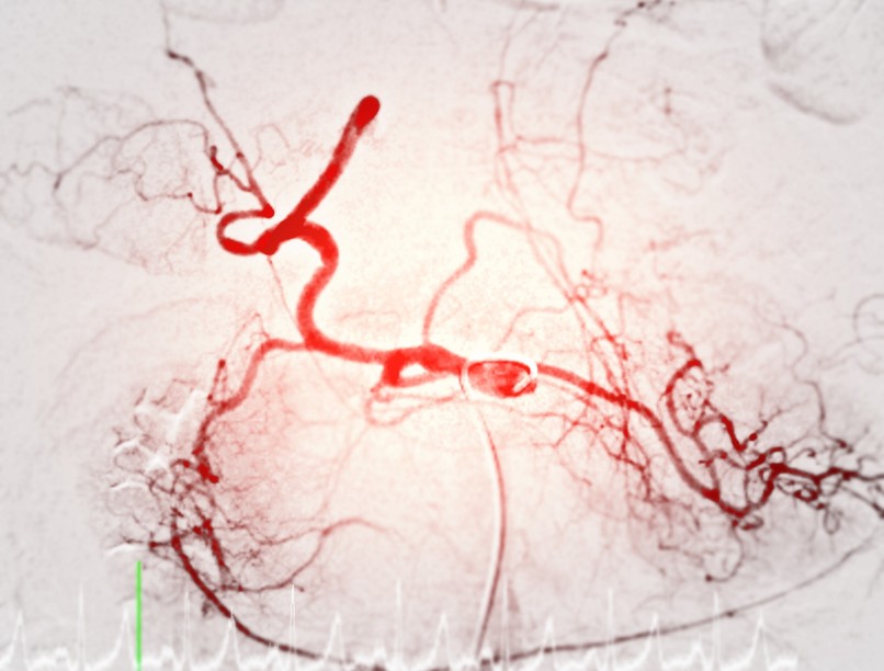 Mi az arteriográfia