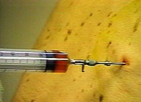 Biopsziás mintavétel