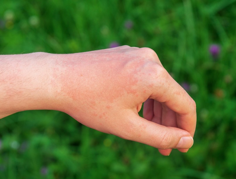 fényérzékenység kiszáradás gyógyszertől