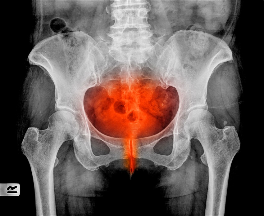 A húgyúti fertőzések esetén 2-4 hetes kezelés szükséges