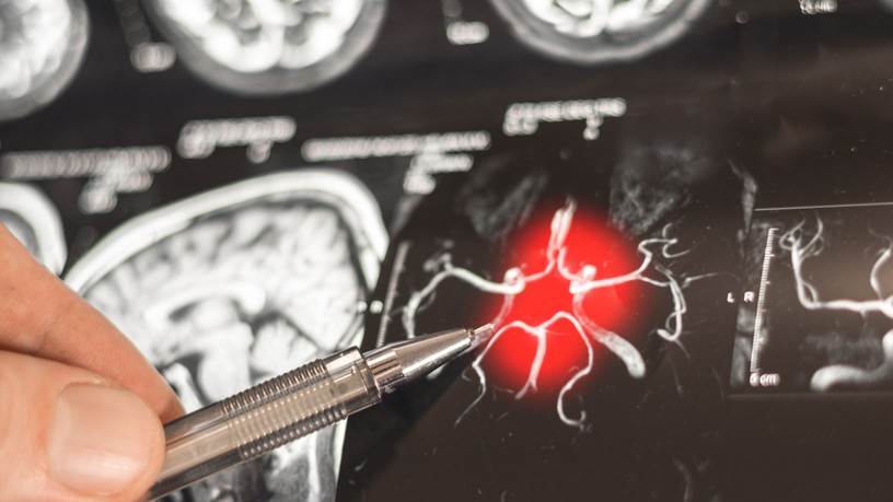 Alzheimer-kór visszafordítása kutatás igéretes eredmény