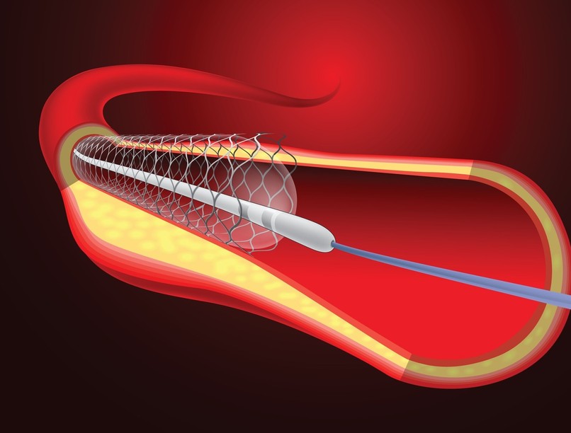 sztent mikor van rá szükség